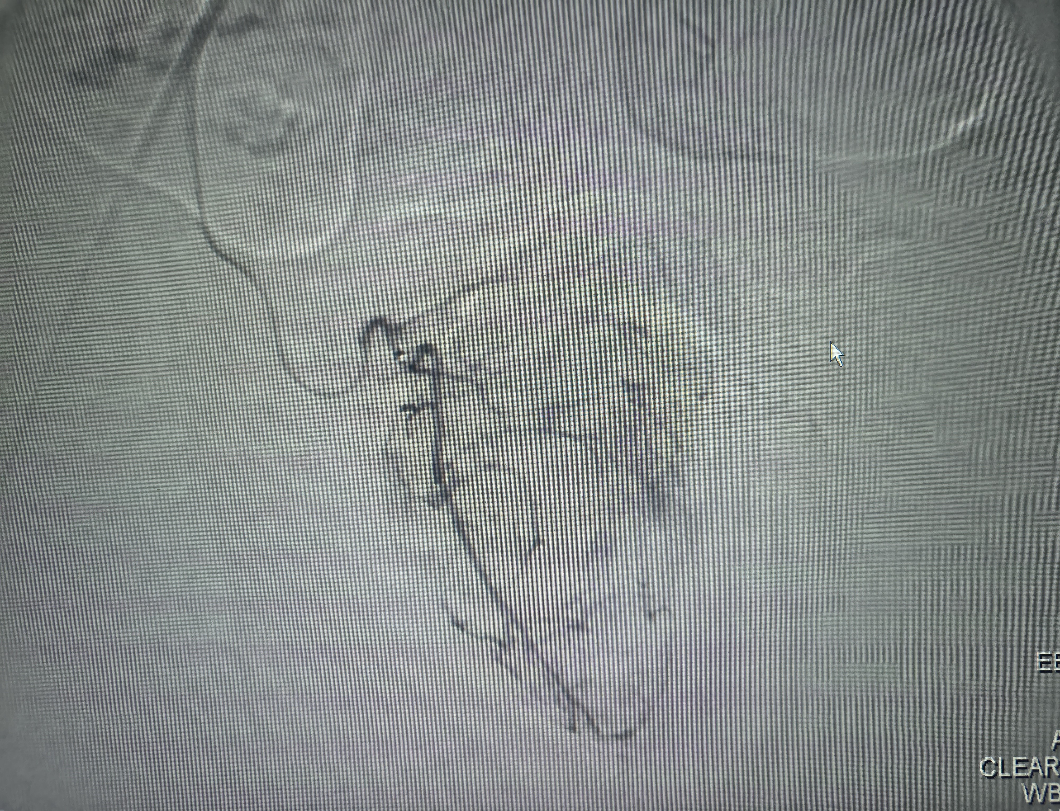 Right Prostatic Artery